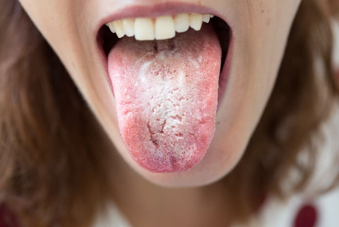 candidiasis bucal