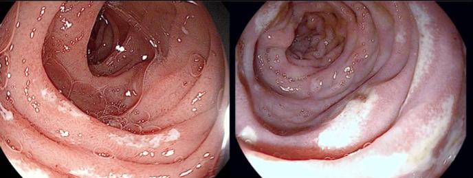 asi se ve la candidiasis intestinal Gráfico sobre la candidiasis intestinal