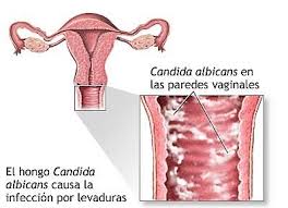 candidiadis vaginal